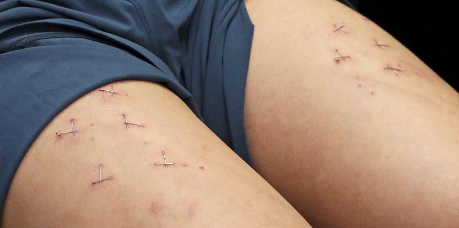 Howard Lam, miembro del partido Democracia de Hong Kong, muestra las heridas en sus piernas causadas por una abrochadora durante una conferencia de prensa en Hong Kong. ( (horizontal-x3)