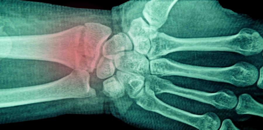 Fractura de muneca tiempo de recuperacion