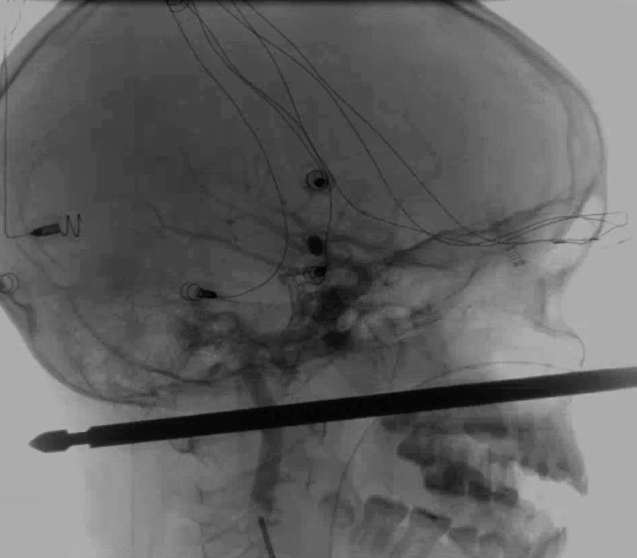 Esta foto proporcionada por Medical News Network muestra el resultado de unos rayos X en la cual se ve una brocheta atravesada en la cabeza del niño Xavier Cunningham. (semisquare-x3)